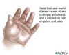 Hand Disease